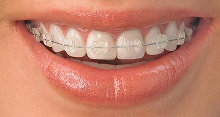 ceramicbraces