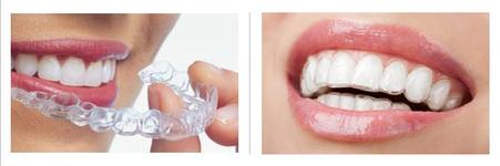 invisalign